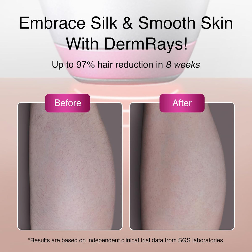 1064nm Diode Laser Hair Removal for Dark Skin Tones V94913