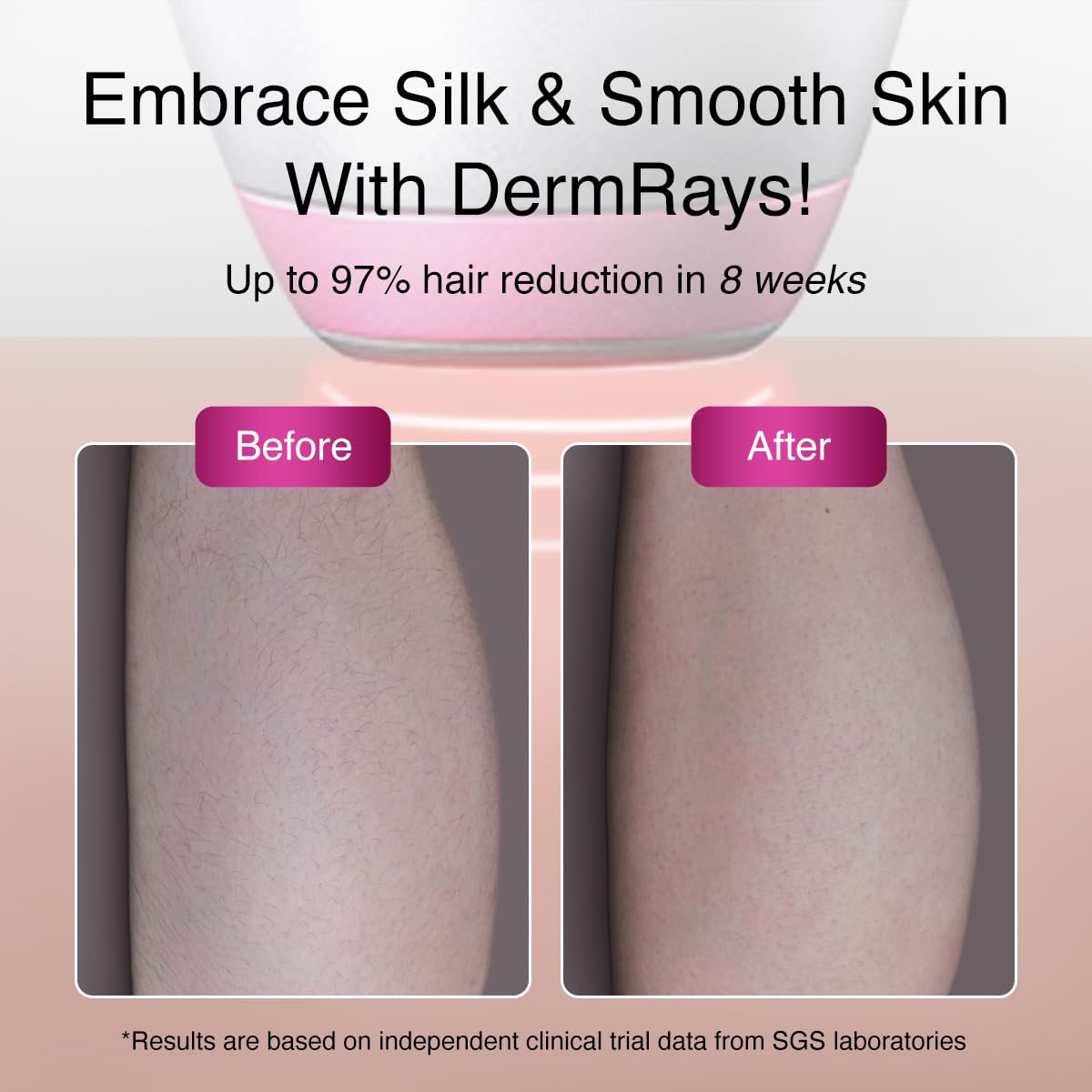 1064nm Diode Laser Hair Removal for Dark Skin Tones V94913